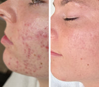 ACNE GRADE 2