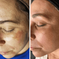 HYPERPIGMENTATION