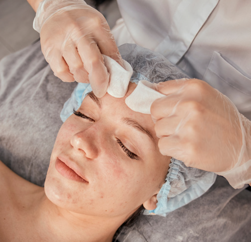 Complex Treatment (Chemical Peel)