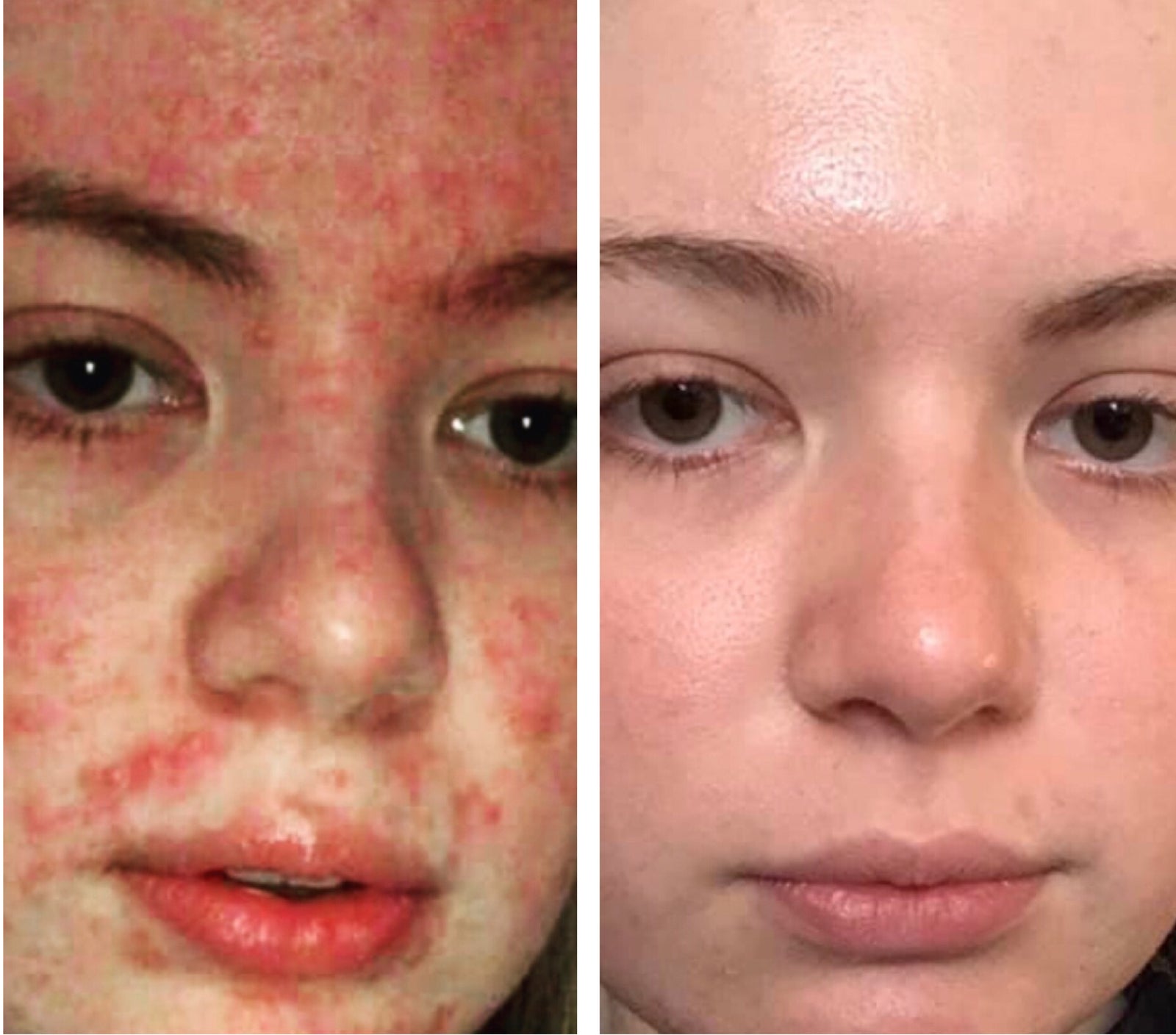 ROSACEA GRADE 2