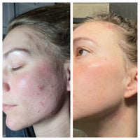 ROSACEA GRADE 1