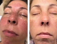 ROSACEA GRADE 3